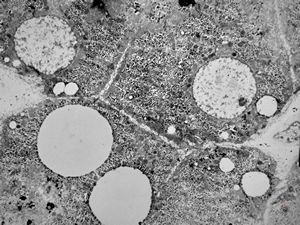 M,11y. | steatosis